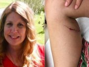 Mujer estrangula a un zorro rabioso por morderle la pierna Mujer estrangula a un zorro rabioso por morderle la pierna