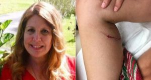 Mujer estrangula a un zorro rabioso por morderle la pierna Mujer estrangula a un zorro rabioso por morderle la pierna