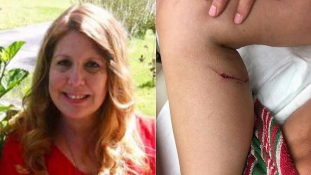 Mujer estrangula a un zorro rabioso por morderle la pierna Mujer estrangula a un zorro rabioso por morderle la pierna