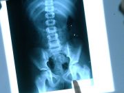Madre descubre los piercings de su hija por una radiografía Madre descubre los piercings de su hija por una radiografía