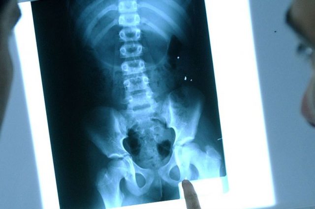 Madre descubre los piercings de su hija por una radiografía Madre descubre los piercings de su hija por una radiografía