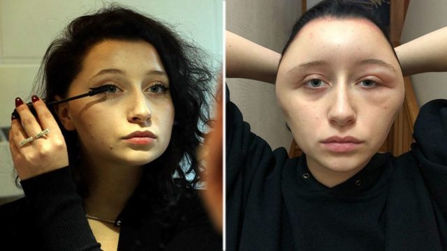 Casi muere por una alergia al tinte de pelo Casi muere por una alergia al tinte de pelo