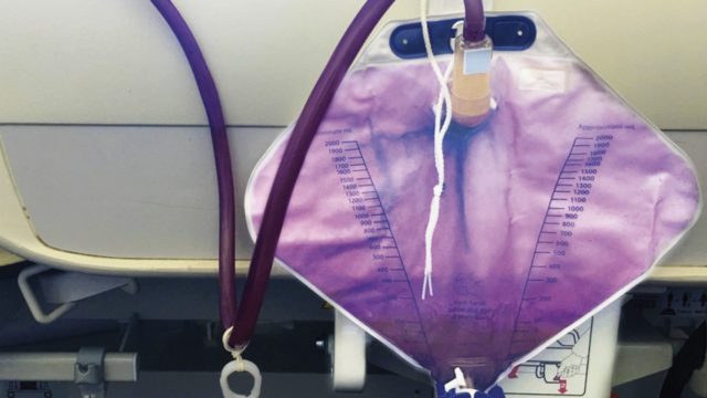 El extraño caso de la mujer que orina de color púrpura El extraño caso de la mujer que orina de color púrpura